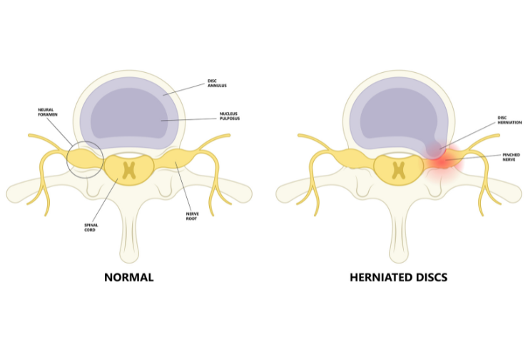 Discectomy