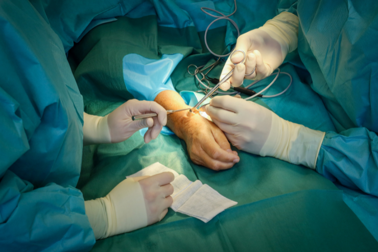 Peripheral Nerve Surgery