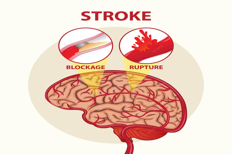 Stroke